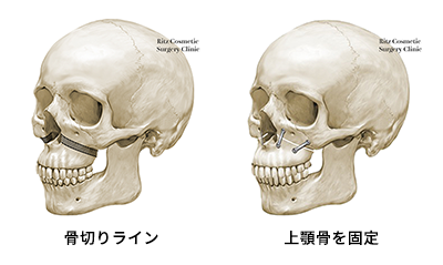 「骨切りライン」「上顎骨を固定」