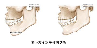 オトガイ形成術